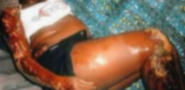 Senegal: Wife scalds pregnant colleague with hot water