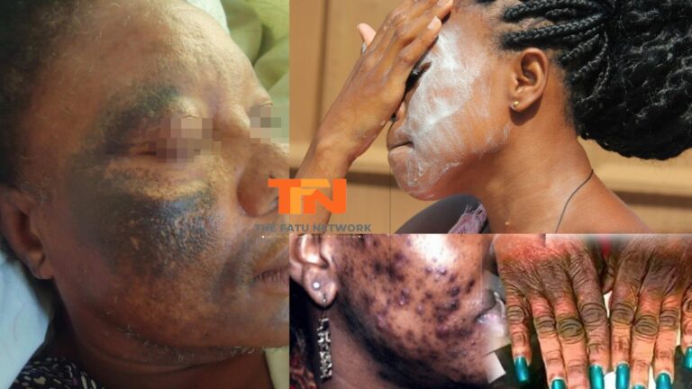 Did You Know That Bleaching Your Skin Is A Crime?