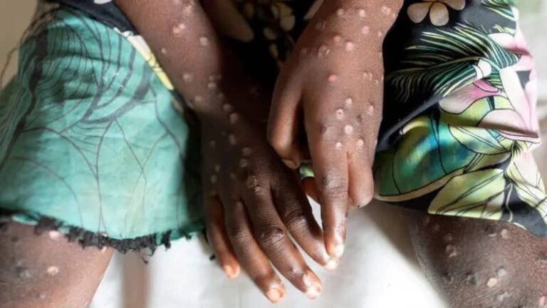 Africa CDC declares Mpox public health emergency