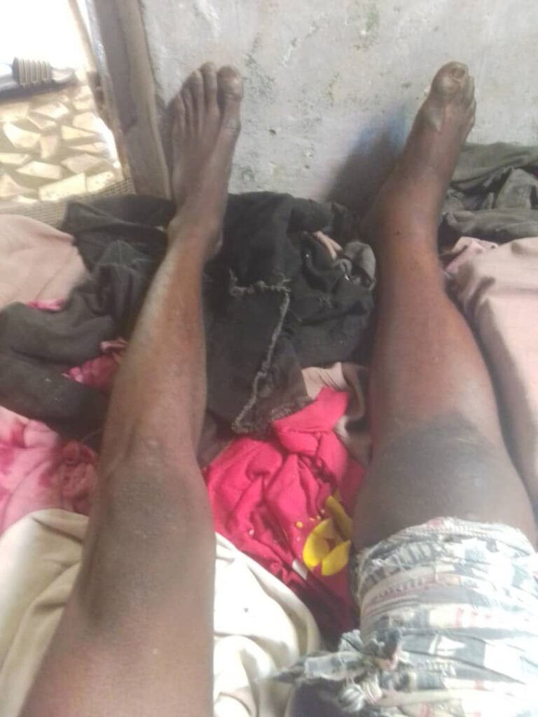 Man Allegedly Assaulted by Drug Squad Officers Pleads for Justice Amidst Leg Fracture